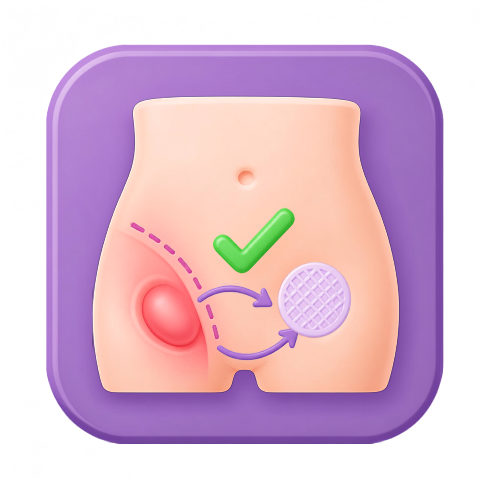 Hernia Inguinal